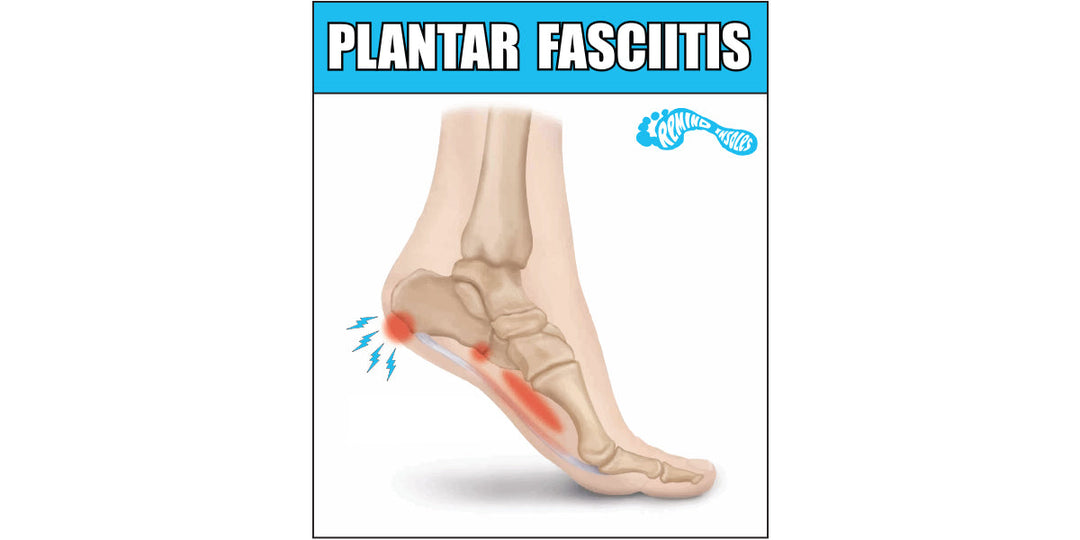 What Is Plantar Fasciitis?