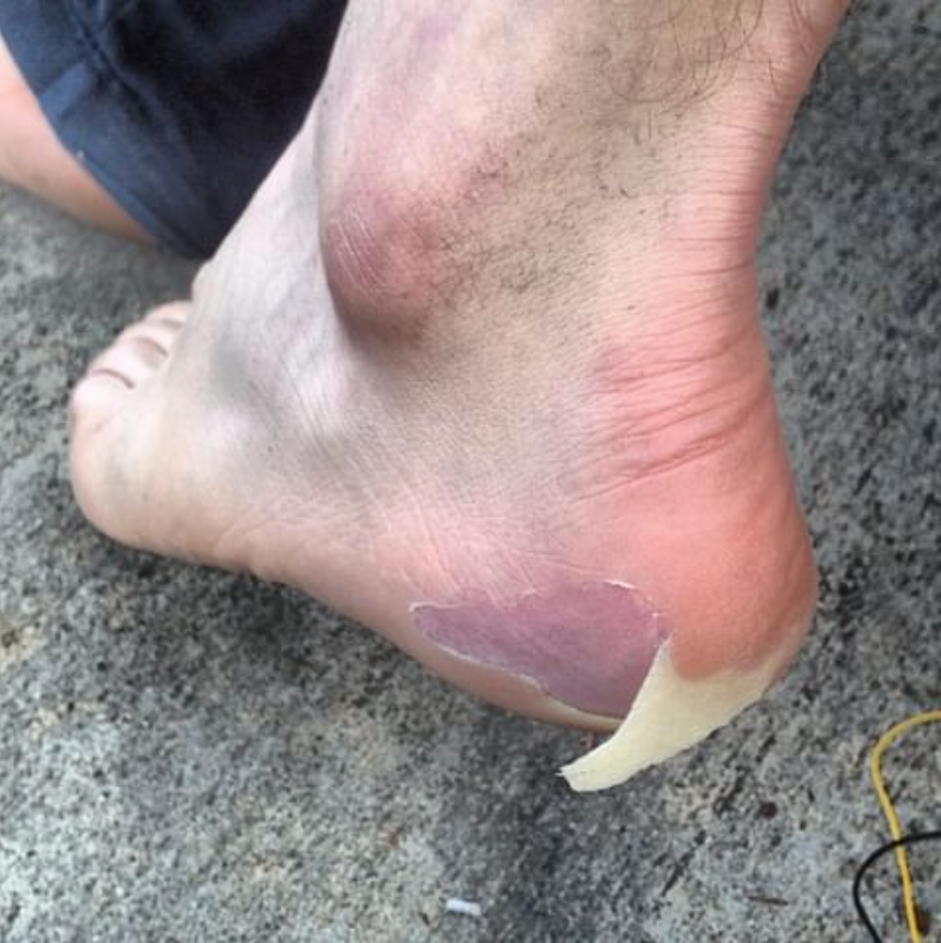 Heel Bruise